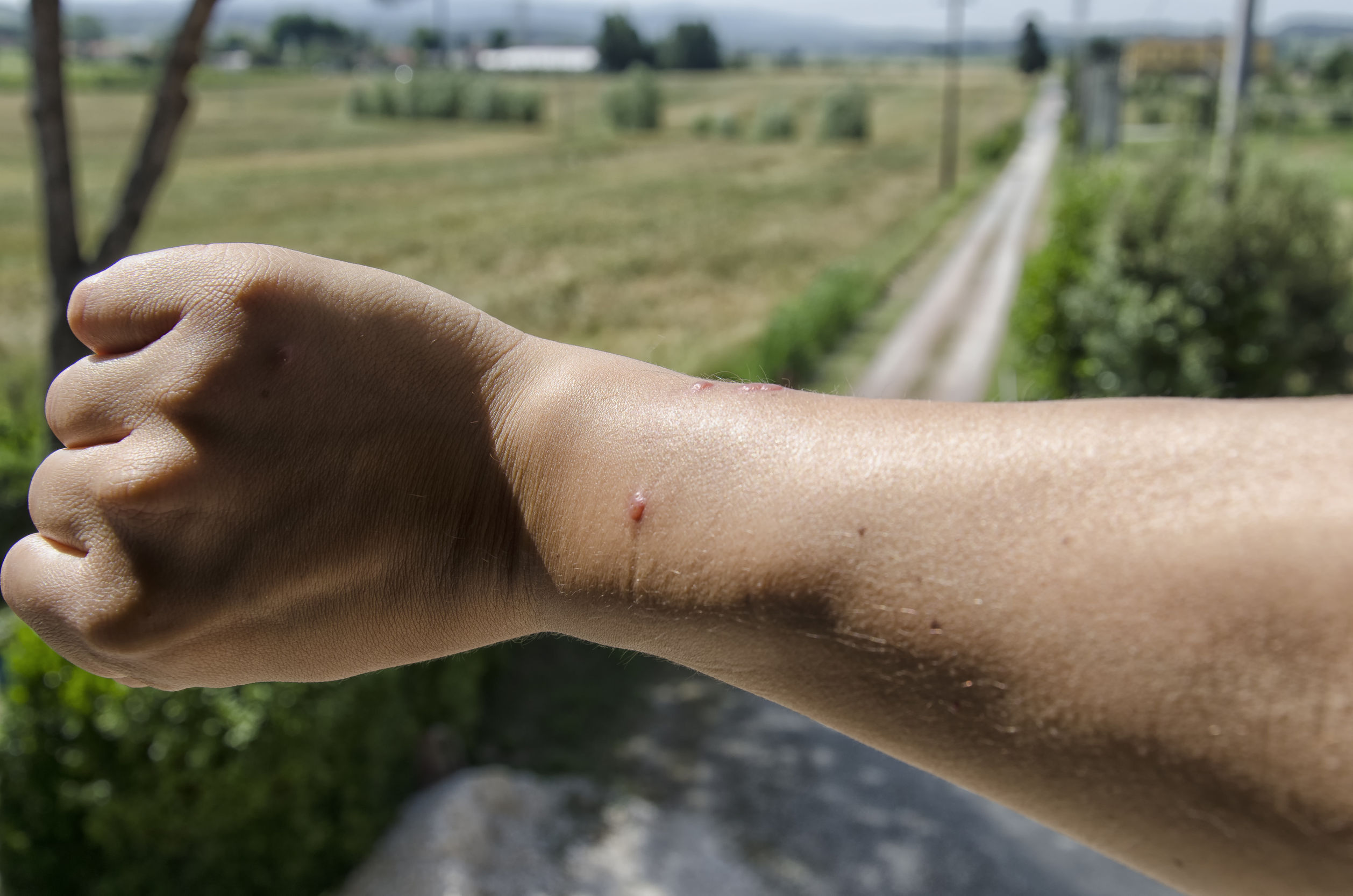 ground spider bite